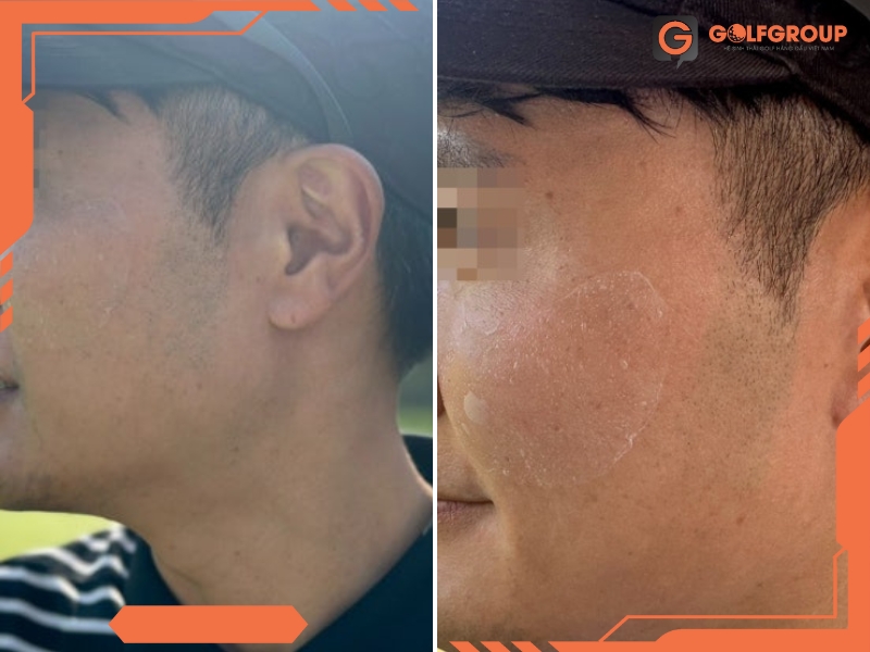 Tác hại của tia UV trực tiếp tới da